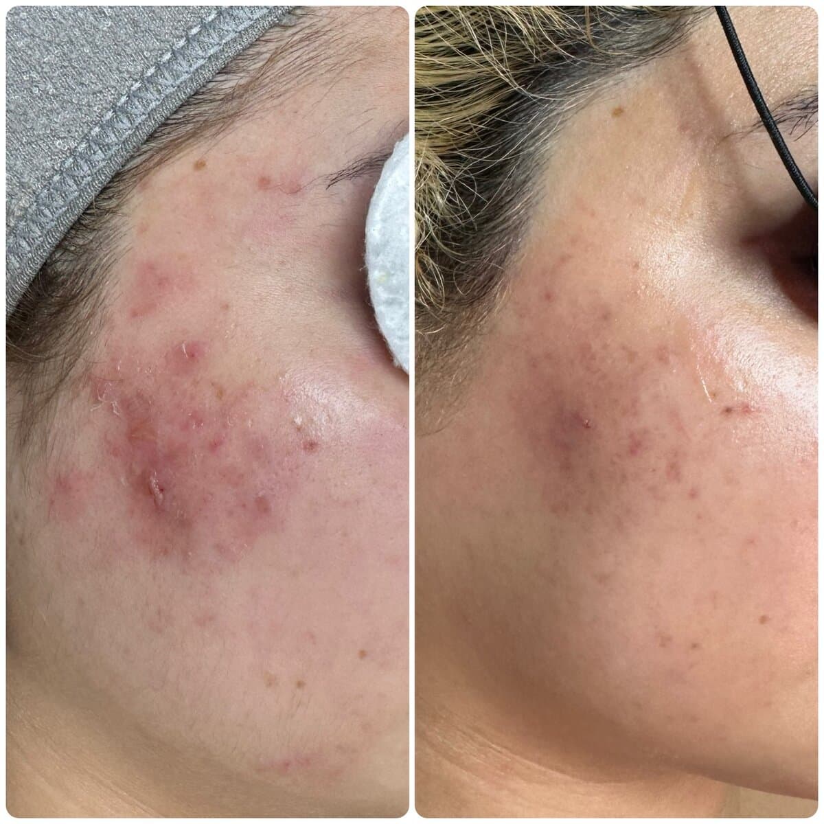 Acne before and after a course of four facials at Beauty Balance by Jo